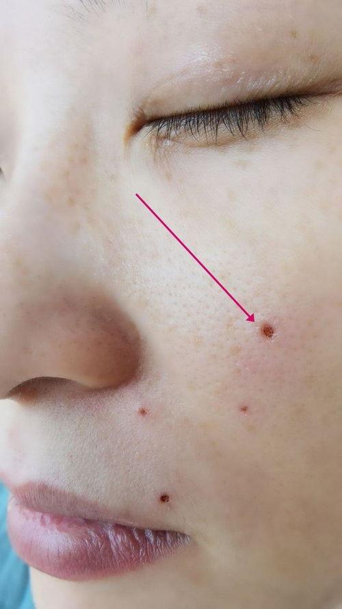 激光去痣视频,高效安全的美容新选择